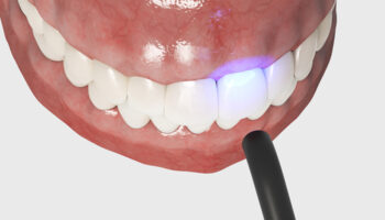 Can Dental Bonding Improve Minor Gaps and Uneven Teeth?