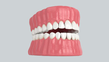 Everything You Need to Know About Permanent Dentures