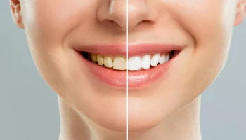 Why Teeth Whitening Is One of the Most Popular Cosmetic Dental Treatments