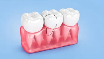 Cracked Tooth Chaos? How Dentists Repair Chips, Splits & Sneaky Fractures