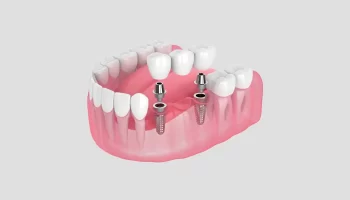 Dental Implant vs. Bridge for One Missing Tooth: Cost, Timeline, and Longevity